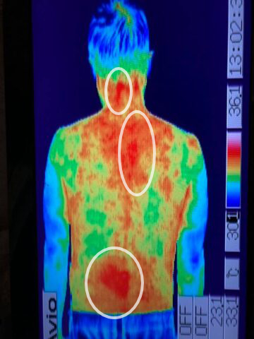 オフィスシマザキ｜ギックリ腰治療_サーモグラフで判る-ギックリ腰の検査